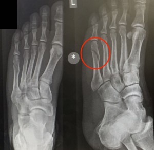 5th Metatarsal Spiral Fracture
